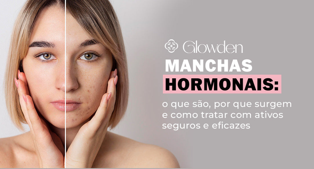 Manchas hormonais: o que são, por que surgem e como tratar com ativos seguros e eficazes