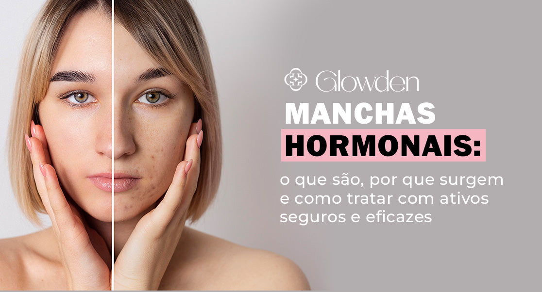 Manchas hormonais: o que são, por que surgem e como tratar com ativos seguros e eficazes