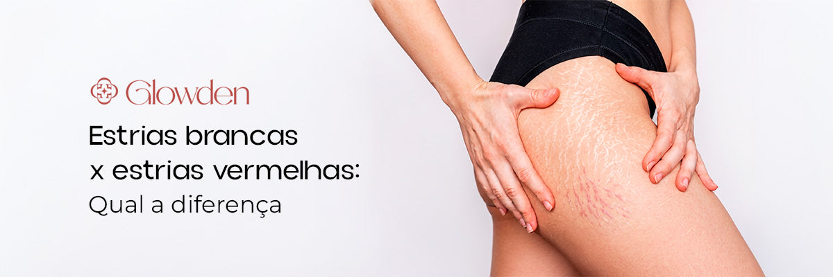 Estrias brancas x estrias vermelhas: qual a diferença e qual tem mais chance de tratamento?