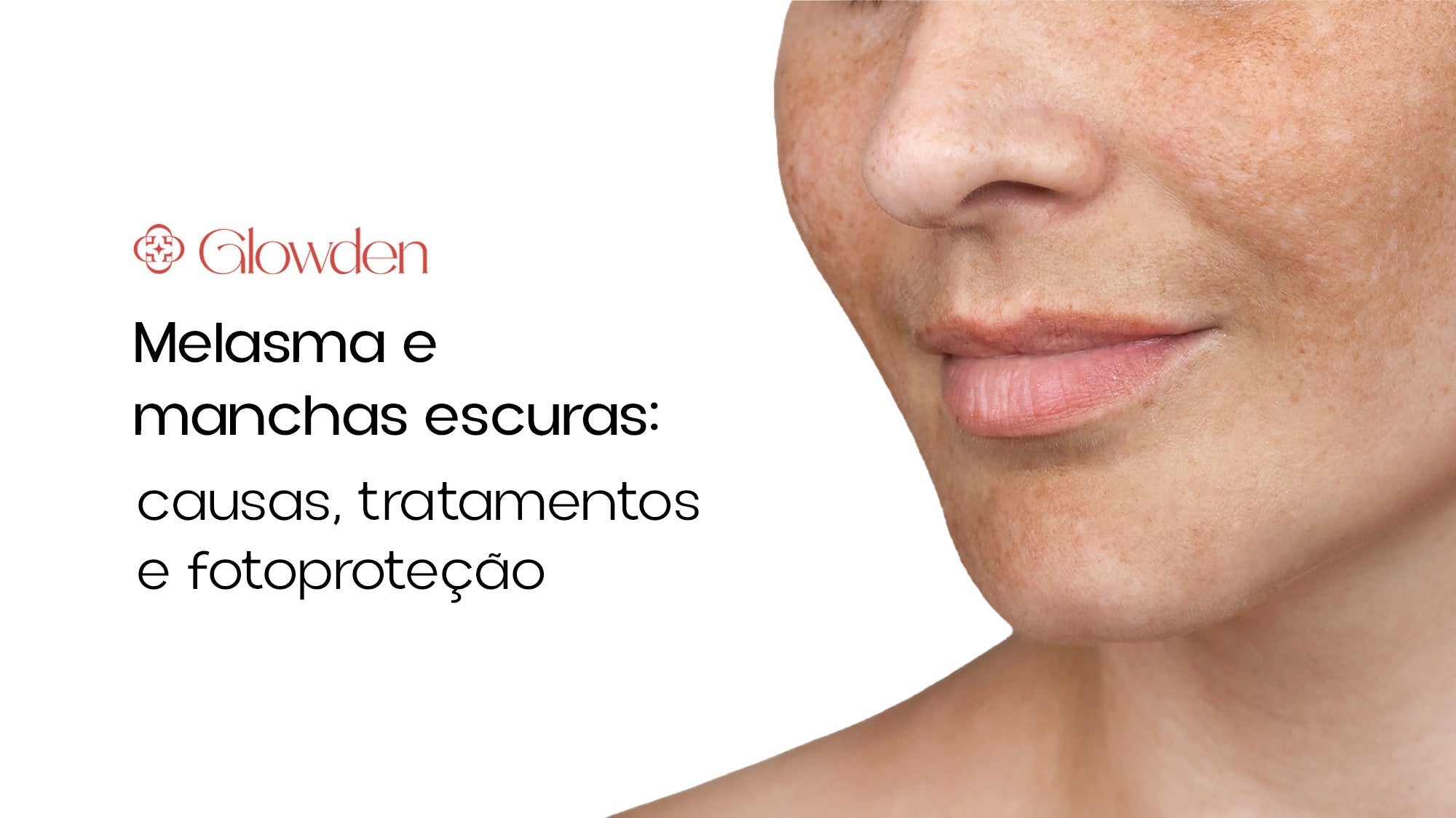 Melasma e manchas escuras: causas, tratamentos e fotoproteção