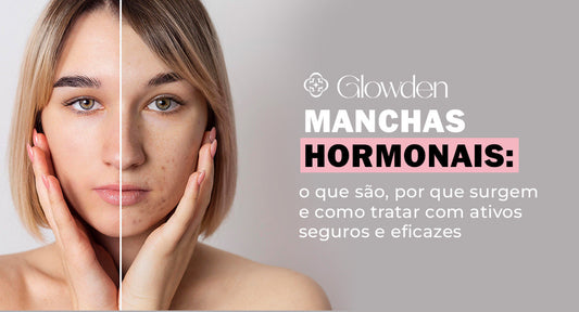 Manchas hormonais: o que são, por que surgem e como tratar com ativos seguros e eficazes