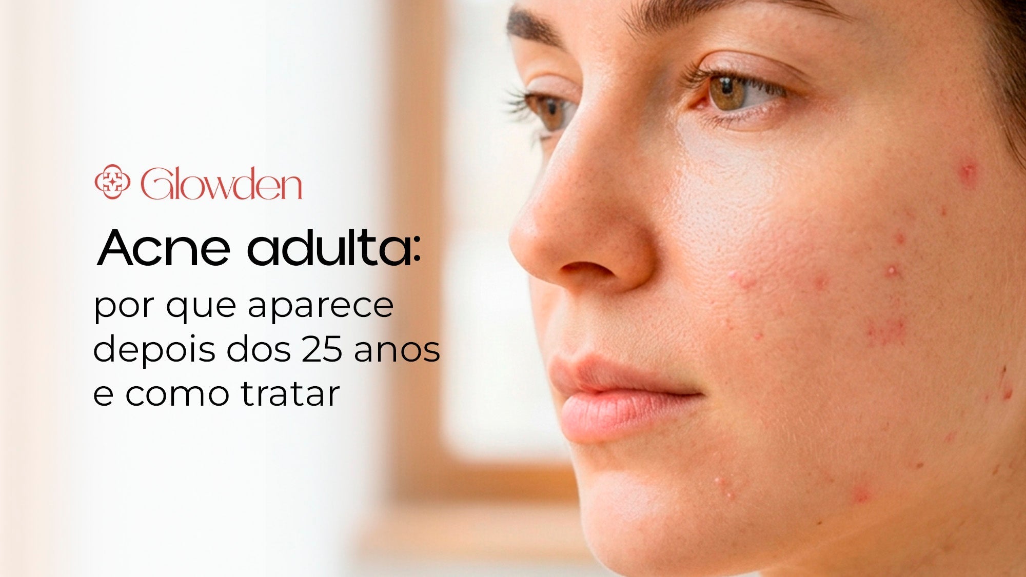 Acne adulta: por que aparece depois dos 25 anos e como tratar